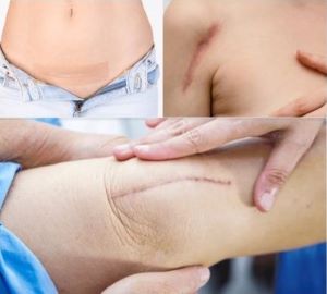 Scar therapy